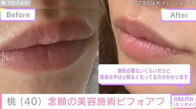 【写真・画像】あいのり桃、念願の美容施術を受けビフォーアフター公開 過去には二重整形や糸リフトなど…　2枚目