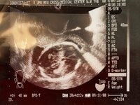 立石美津子『(その3)出生前診断ではわからない障害』