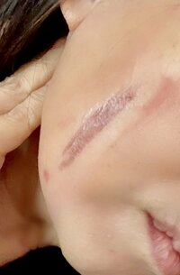 アグネス・チャン『今日の傷の治り具合』