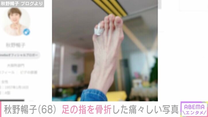 【写真・画像】2023年に食道がん寛解・秋野暢子（68）、足の小指を骨折し痛々しい写真を公開「これは絶対痛い…」心配の声　2枚目