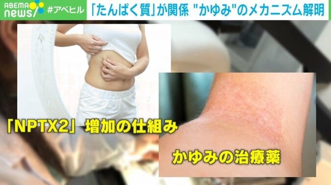 何度かいても治らない…“かゆみの悪循環”から抜け出すには? 教授が仕組みを解説 1枚目