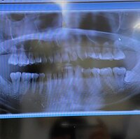 しょうくん『抜歯その後』