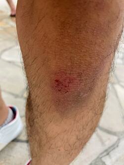  だいたひかるの夫、転倒し爪下血腫になった足の指「痛々しい」「お大事に」の声 