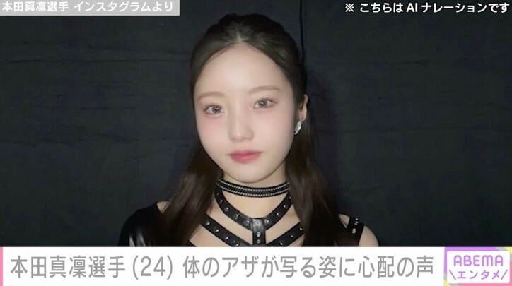 【写真・画像】本田真凜選手、体にできた大きなアザが写る姿に心配の声「痛々しい」「けがだらけやん」「すごく痛そう」　1枚目