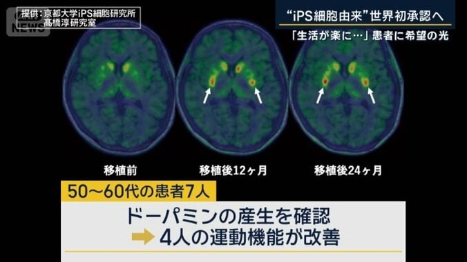 細胞を移植した後の患者の脳