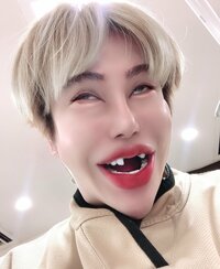 アレン『歯抜け人生だけは、No❗️No❗️No❗️』