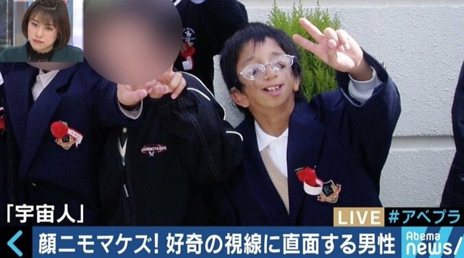 「ワンダー 君は太陽」で描かれたトリーチャーコリンズ症候群　“当事者”石田祐貴さんが視線を浴びながらも街を歩く理由 6枚目