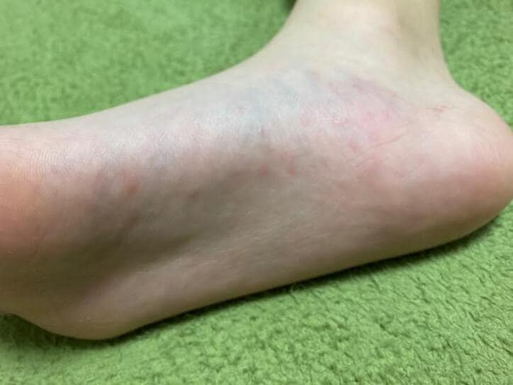  ノッチの妻、次女が訴えた異汗性湿疹の症状「右足側面に増えてきた」 