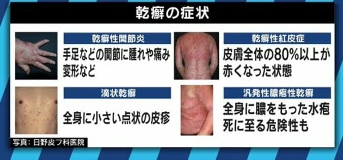 患者が告白「結婚は難しいと言われショックを受けた」　道端アンジェリカも誤解と偏見に苦しむ「乾癬」とは 10枚目