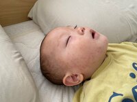 江原千鶴『突発性発疹の解熱後の発疹!』