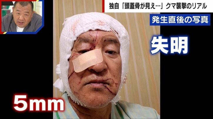 「頭蓋骨が開いてた。もう死ぬんだなと」クマ被害者を独自取材　頭は30針以上の怪我、耳たぶを噛みちぎられ、あと5mmで失明の恐れも…被害者が語った「恐怖の瞬間」