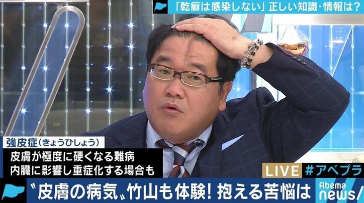 患者が告白「結婚は難しいと言われショックを受けた」 道端アンジェリカも誤解と偏見に苦しむ「乾癬」とは