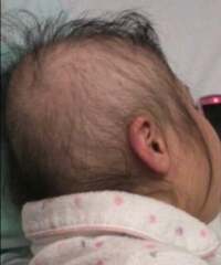 友寄蓮『映画では描かれない白血病〜抗がん剤による脱毛のリアル　前編〜』