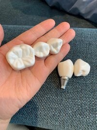 北斗晶『歯医者さんでインプラント』