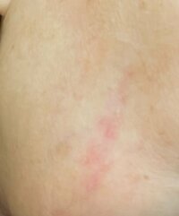 アグネス・チャン『火傷の傷の状況』