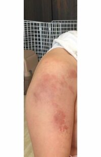 キンタロー。『腕の具合　色素沈着』