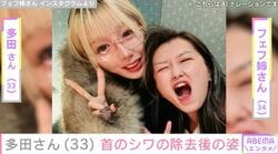 『月曜から夜ふかし』フェフ姉さんの友人・多田さん（33） 首のシワの除去施術後のダウンタイム中の様子を公開