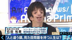 「ワンダー 君は太陽」で描かれたトリーチャーコリンズ症候群　“当事者”石田祐貴さんが視線を浴びながらも街を歩く理由
