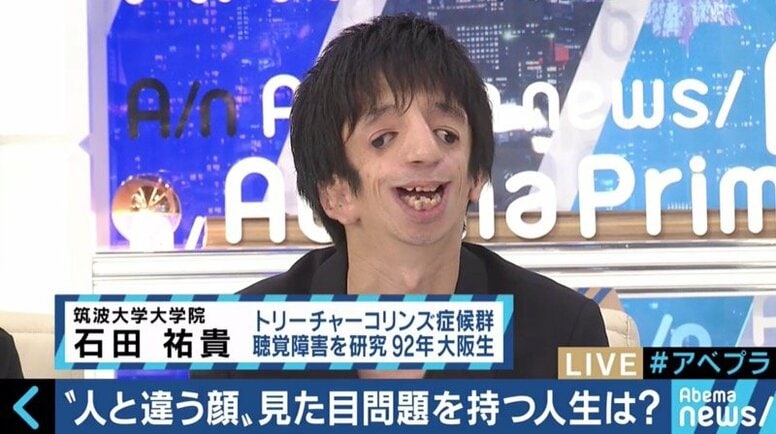 「ワンダー 君は太陽」で描かれたトリーチャーコリンズ症候群　“当事者”石田祐貴さんが視線を浴びながらも街を歩く理由