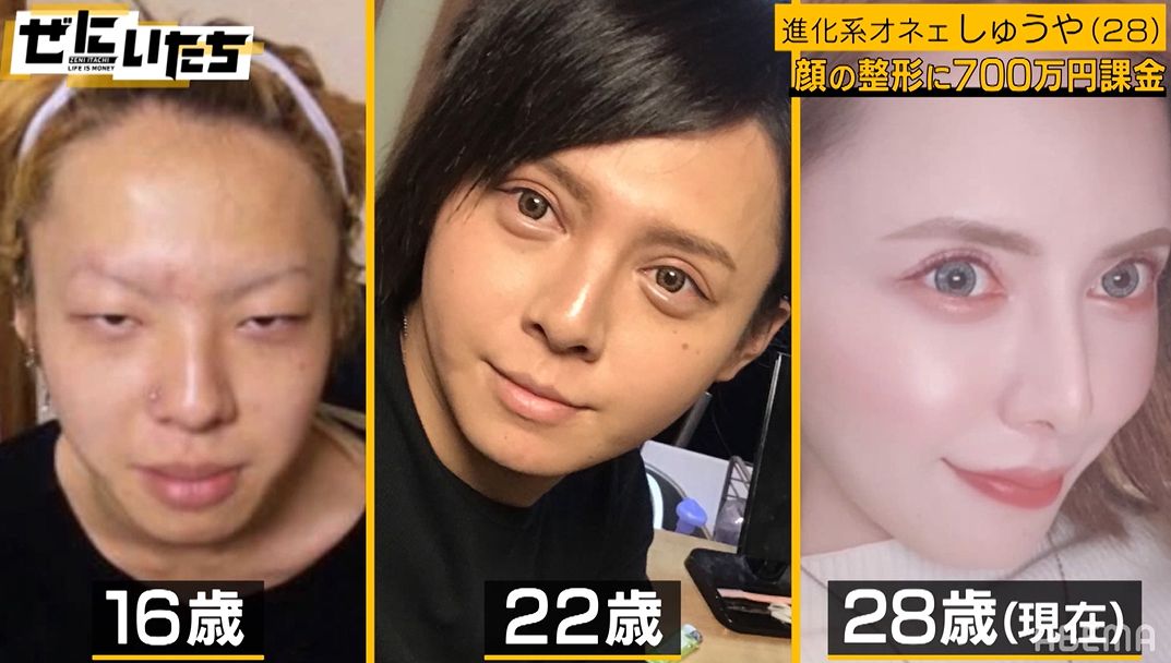 整形に700万課金 衝撃のビフォーアフター写真にかまいたち濱家 俺もああなれんのか 22年7月12日 Biglobeニュース