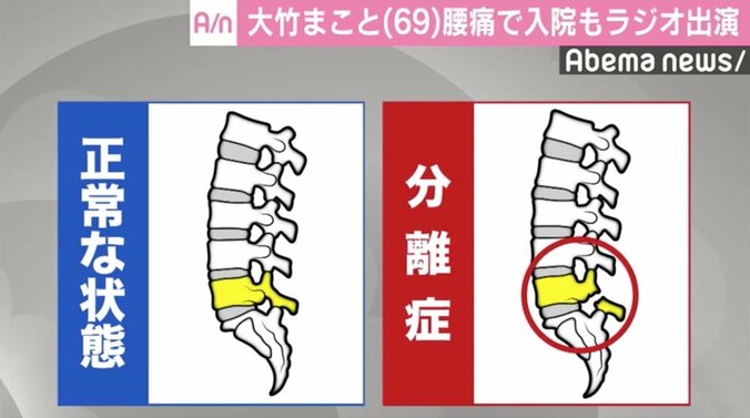 大竹まこと「腰椎分離症」での入院を報告、病院から駆けつけラジオ出演 2枚目