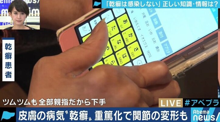 患者が告白「結婚は難しいと言われショックを受けた」 道端アンジェリカも誤解と偏見に苦しむ「乾癬」とは