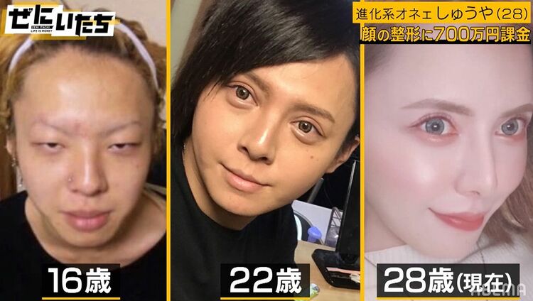 写真・画像】整形に700万課金、衝撃のビフォーアフター写真に