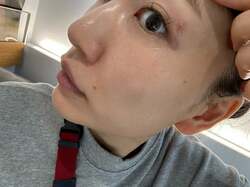  あいのり・桃、目の上の濃いシミを取りに行った結果を報告「1番老けて見える要因」 