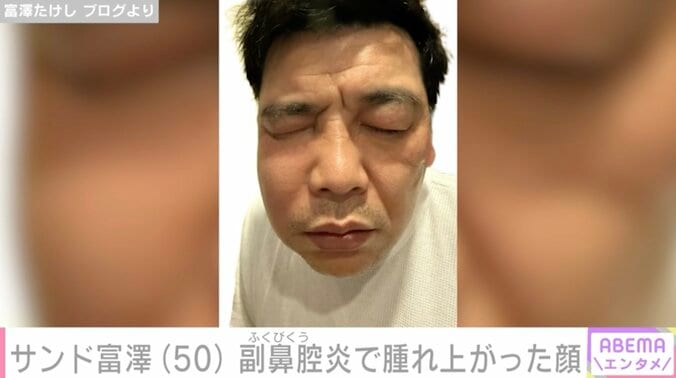 【写真・画像】サンド富澤たけし（50）、副鼻腔炎で腫れ上がった顔を公開「こんなに腫れるんですね」　2枚目