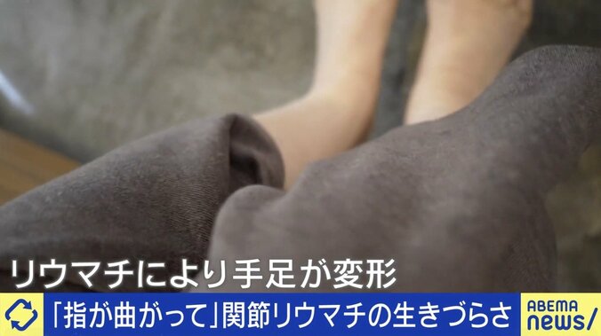 関節リウマチとは