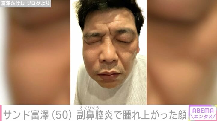 【写真・画像】サンド富澤たけし（50）、副鼻腔炎で腫れ上がった顔を公開「こんなに腫れるんですね」　2枚目