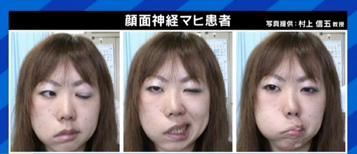 自分の顔が自分の顔じゃなくなってしまう感じが残った ジャスティン ビーバーも罹患した ラムゼイ ハント症候群 発症のピークは代と50代に 国内 Abema Times