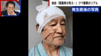 【映像】「死を覚悟」クマ被害者が駆除への苦情に苦言
