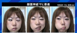 「自分の顔が自分の顔じゃなくなってしまう感じが残った」ジャスティン・ビーバーも罹患した“ラムゼイ・ハント症候群”、発症のピークは20代と50代に
