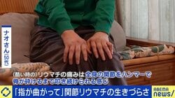 「電動ドリルでガリガリされる感覚」「関節を雑巾絞り」高市総理も苦しんだ関節リウマチ 当事語る生きづらさ