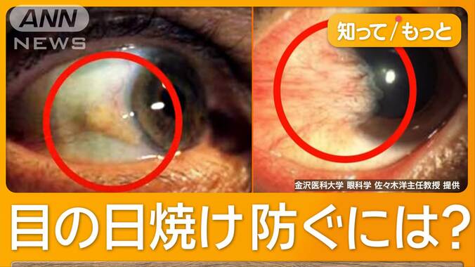 「目の日焼け」白内障や老眼に？　紫外線入りやすくなる秋　熱中症で白内障リスク4倍 1枚目