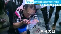 激化する香港デモ 耳を噛みちぎられた男性も