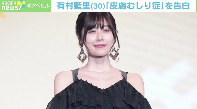 有村藍里も悩む「皮膚むしり症」 6歳で発症した経験者が語る治療“3つのステップ”と専門家による習慣逆転法とは 1枚目