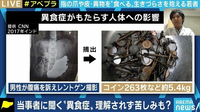 いけないと分かっていても…緊張や不安などを感じると爪や髪の毛を食べてしまう「異食症」の女性 5枚目