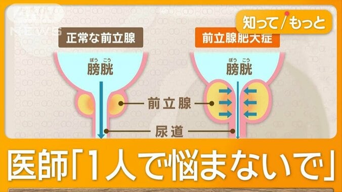 40歳以上「3人に1人」尿漏れ経験　“チョイ漏れ”男性増加　「仕事に集中できない」 1枚目