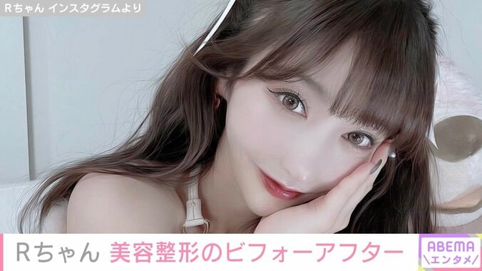 “整形総額約2000万円”Rちゃん「実は整形してたんだけど気づいた？」新たな施術のビフォーアフターを公開 1枚目