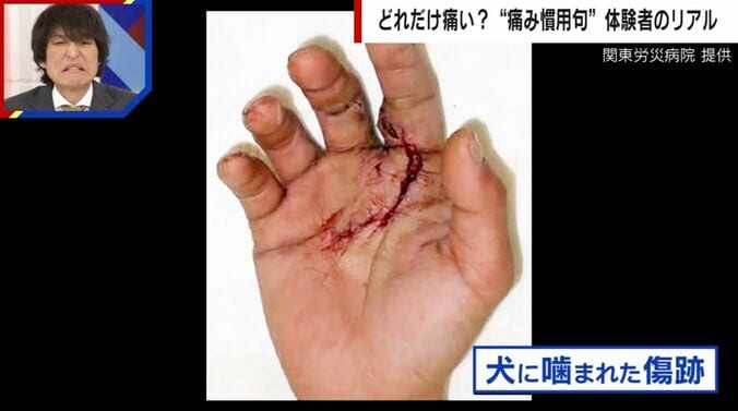 実際に飼い犬に手を噛まれた人の写真