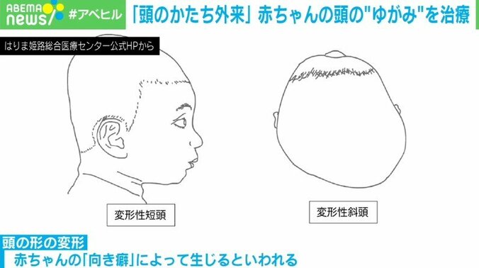 頭の変形を専門に扱う“頭のかたち外来”  費用は数十万円　成長で改善？治療したほうがいい？判断の難しさも 2枚目