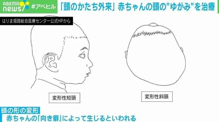 頭の変形を専門に扱う“頭のかたち外来”  費用は数十万円　成長で改善？治療したほうがいい？判断の難しさも