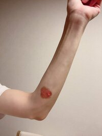 高橋真麻『火傷…その後』