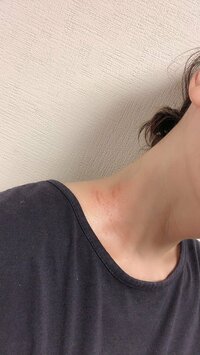 高橋真麻『首の傷』