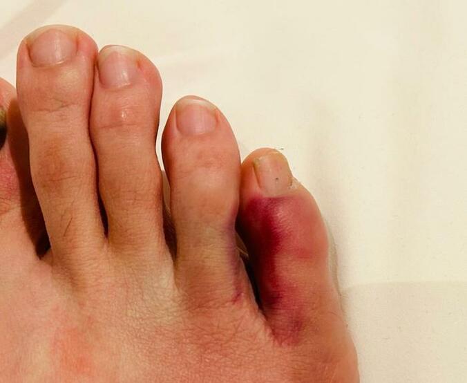  ココリコ・遠藤の妻、腫れて赤紫色になった足の小指「痛すぎて、、、靴も履けない状態」  1枚目