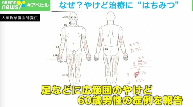 やけども回復？“はちみつ”の秘めたパワー… 医師「研究段階のため従来の方法で治療を」 2枚目