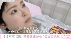 34歳で余命宣告を受けたミミポポ（38）、救急搬送から12日の現状「まだ体はあちこち痛かったり苦しかったり」