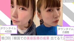 あいのり桃「韓国での美容医療の成果、出てる？」ダウンタイム4日目と2週間後を公開